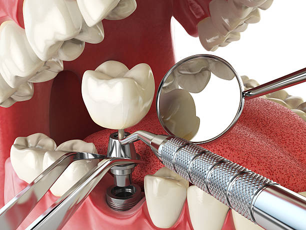 Best Emergency Root Canal Treatment in Orchard City, CO